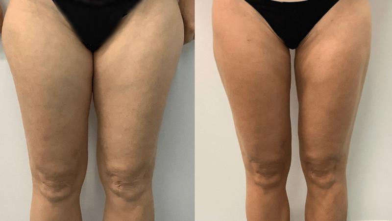 Odchudzanie ud na siłowni