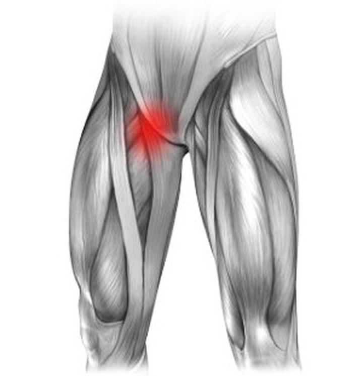 Naciągnięcie mięśnia pachwiny