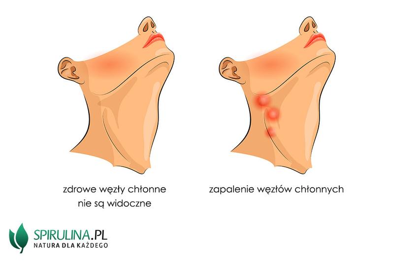 Objawy zapalenia mięśnia szyjnego