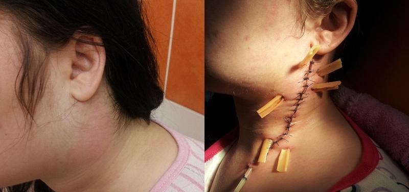 Przyczyny i czynniki ryzyka zapalenia mięśnia szyjnego