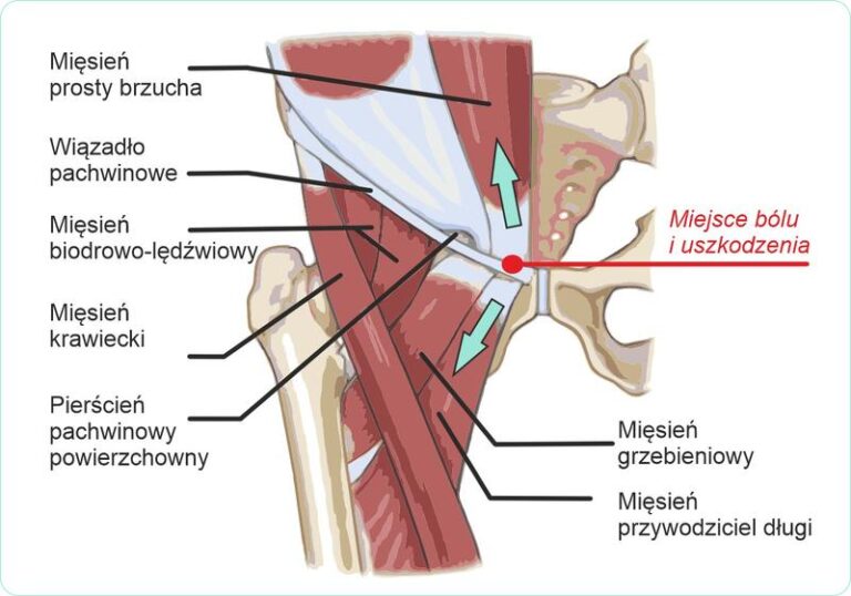 Jak rozpoznać naciągnięty mięsień pachwiny? Objawy, na które warto zwrócić uwagę