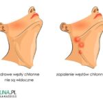 Jak rozpoznać objawy zapalenia mięśnia szyjnego? Przewodnik po najważniejszych symptomach