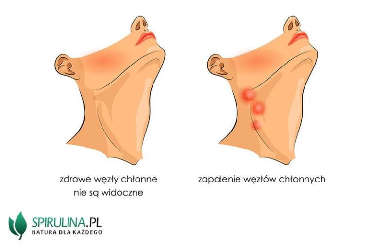 Jak rozpoznać objawy zapalenia mięśnia szyjnego? Przewodnik po najważniejszych symptomach