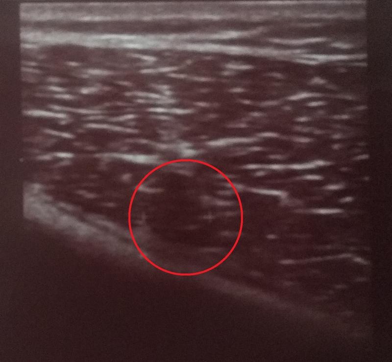 Objawy naciągnięcia mięśnia czworogłowego