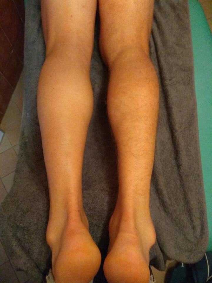 Naderwanie mięśnia brzucha – objawy