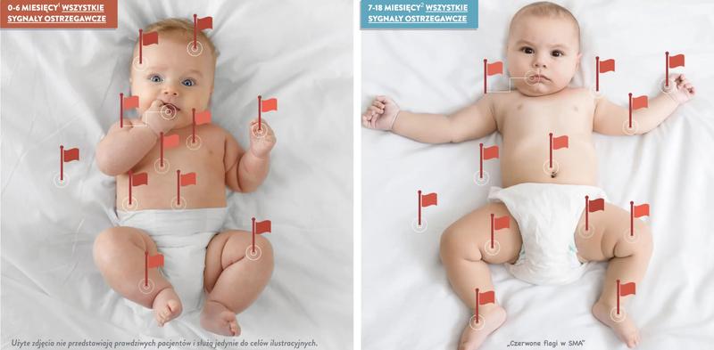 Rehabilitacja i fizjoterapia przy zaniku mięśni kręgosłupa