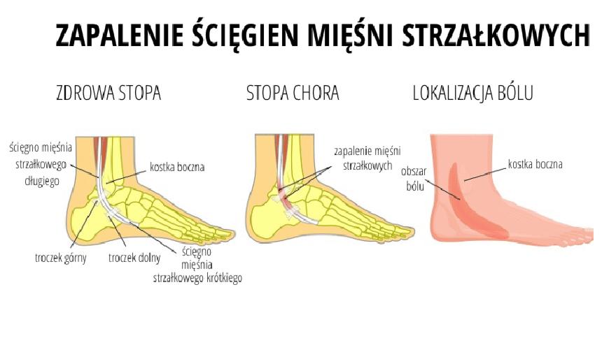 Objawy zapalenia mięśni