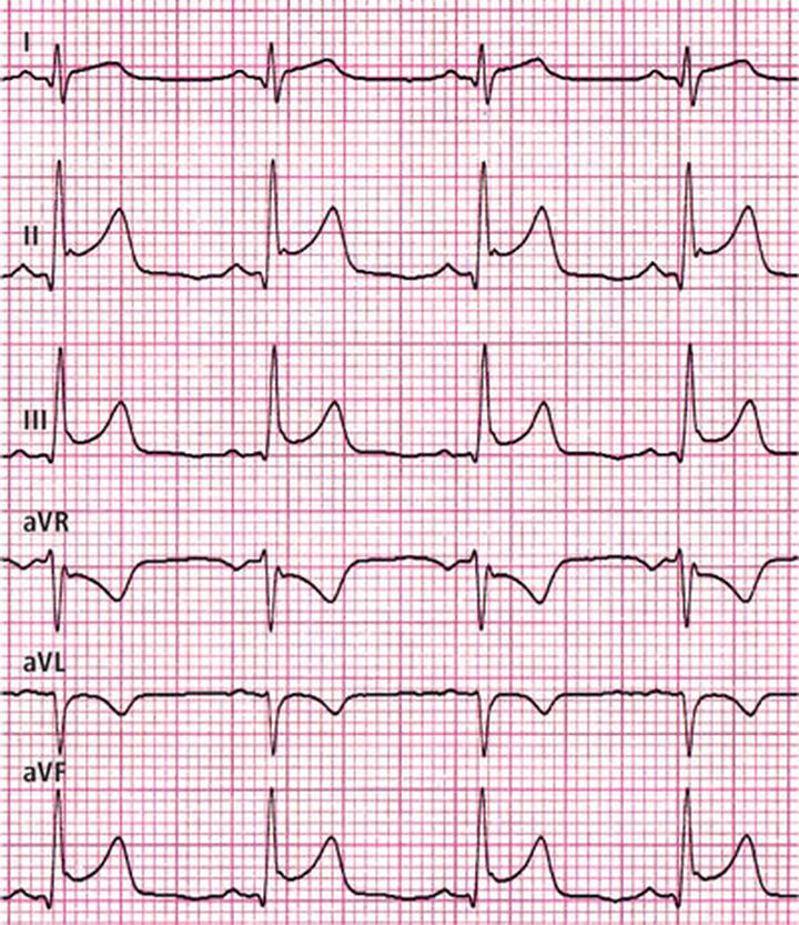 Zapalenie mięśnia sercowego