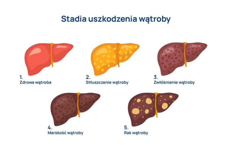 Jakie zmiany w diecie pomogą przy stłuszczeniu wątroby?
