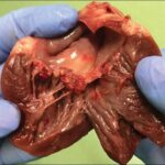 Objawy zapalenia mięśnia sercowego, których nie możesz zignorować