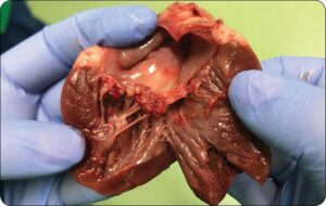 Objawy zapalenia mięśnia sercowego, których nie możesz zignorować