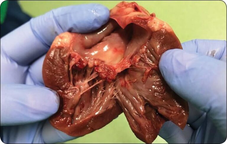 Objawy zapalenia mięśnia sercowego, których nie możesz zignorować