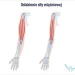 Objawy osłabienia mięśni nóg – jak je rozpoznać i kiedy udać się do lekarza?