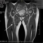 Guz mięśnia uda – jakie objawy powinny nas zaniepokoić?